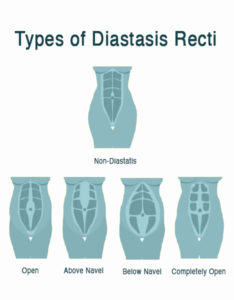 Diastasis Recti: Abdominal Separation FAQs