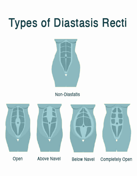 Diastasis Recti Diagram white bg2